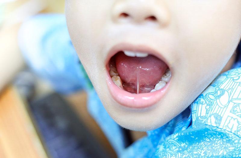 Biểu hiện dính thắng lưỡi ảnh hưởng đến phát âm ở trẻ lớn, nói ngọng, khó tạo âm thanh